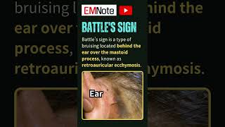 Battles Sign Retroauricular Ecchymosis [upl. by Otreblasiul987]