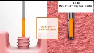 TrapLock Trap lock Bone Marrow Trephine Biopsy Needle Method of use [upl. by Combes]