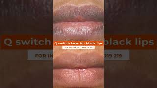 You Will Never Believe These Bizarre Truths Behind Q Switch Laser For Black Lips blacklips [upl. by Aynotahs]