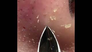 Blackhead Removal With Tweezer 1 Hour [upl. by Woodrow]