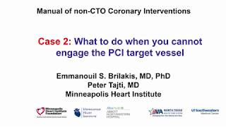 Case 2 PCI Manual  What to do when you cannot engage the PCI target vessel [upl. by Depoliti]