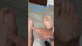 ￼ No More Bunion Pain [upl. by Buzzell456]