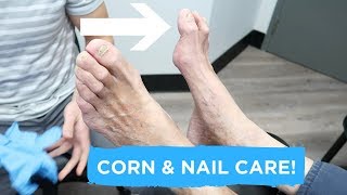 Apical Heloma Durum Treatment  Corn and Nail Care [upl. by Enad]