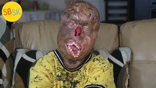 Surviving Severe Burns Doctors Say He’s a Miracle [upl. by Sevik293]