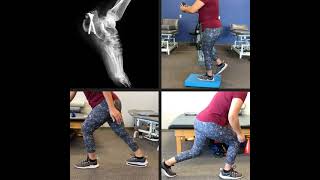 Calcaneal Fracture Exercises Real Patient [upl. by Hardwick]