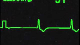 Idioventricular Rhythm  ECG Simulator  Arrhythmia Simulator [upl. by Oecam]