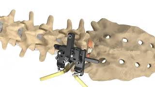 MAS TLIF  Patient Animation [upl. by Grenville]