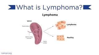 Lymphoma Causes and Treatments [upl. by Towroy]