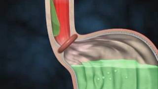 What to do about Acid Reflex GERD GastroEsophageal Reflux [upl. by Eelitan]