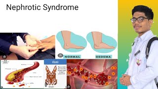 Nephrotic Syndrome  Signs and Symptoms of Nephrotic Syndrome [upl. by Atinus]