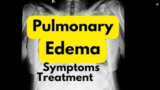 Pulmonary edema symptoms treatment in Hindi  lungs me Pani bharne se kya hota hai [upl. by Alehtse]