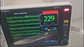 Cardioversión de taquicardia supraventricular con adenosina en Cruz Roja Gómez Palacio [upl. by Carroll799]