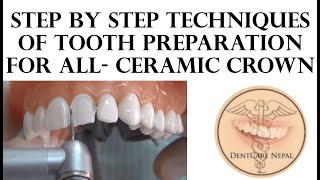 STEP BY STEP  Tooth Preparation Technique for All Ceramic Anterior Crown [upl. by Daile]