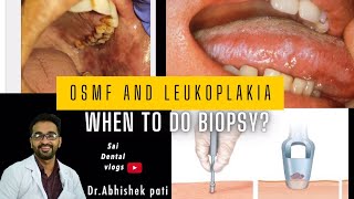 Osmf and leukoplakia when to do biopsy [upl. by Stephana]