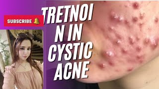 Use of isotretinoin in cystic acne [upl. by Nosneh]