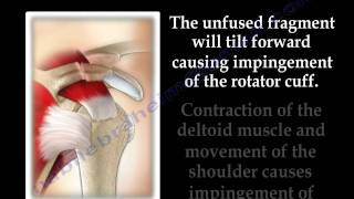 The Acromion Os Acromiale  Everything You Need To Know  Dr Nabil Ebraheim [upl. by Linn]