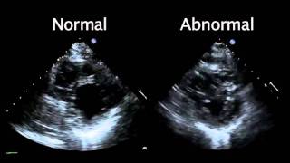 Echocardiogram from the Patient Compared with That from a Normal Control  NEJM [upl. by Adnael375]