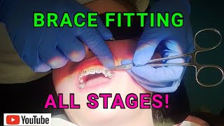 How Braces Are Put On  AMAZING Orthodontist Explained Each Step [upl. by Atiuqat]