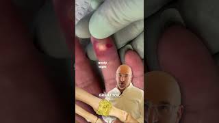 Big Toe Pain  Everything You Need To Know  Dr Nabil Ebraheim [upl. by Lux]