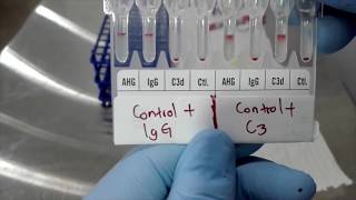 Procedimiento Coombs directo poliespecífico y monoespecífico en tarjeta [upl. by Edroi]