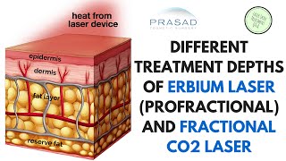 The Different Treatment Depths of ProFractional Erbium Laser and Fractional CO2 Laser [upl. by Anyahs]