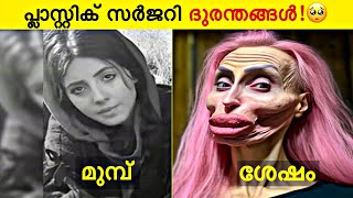 പ്ലാസ്റ്റിക് സർജറി ചെയ്ത് പണി പാളി🥲  Before And After Plastic Surgery [upl. by Milde699]