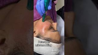 Dermapen microneedling treatment For Brightening skin👍microneedling dermapen skincare [upl. by Charlean306]