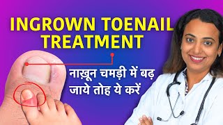 Ingrown Toenail Treatment in Hindi  Home Remedy Using Dental Floss Cotton [upl. by Coniah675]