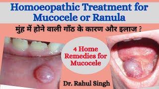 How To Treat Mucocele होंठ की गाँठ का इलाज और कारण Homeopathic Medicine for Oral Mucocele amp Ranula [upl. by Volnak824]