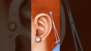 ASMR ear piercing removal Treatment clean ear piercing amp pus 2d animation [upl. by Keraj]