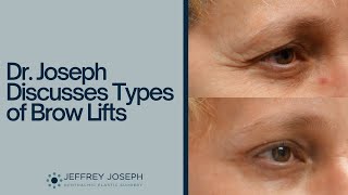 Different Types of Brow Lifts Explained  Which Brow Lift Technique is Right for You [upl. by Ntisuj]