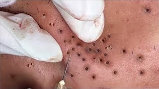 Top of Blackhead Extraction Video 2020  Best Blackhead Removal Videos 2020 [upl. by Poulter278]