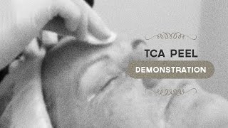 35 TCA peel demonstration [upl. by Imer]