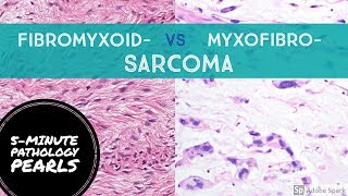 FIBROmyxo vs MYXOfibro Sarcoma Made Simple 5Minute Pathology Pearls [upl. by Jews]