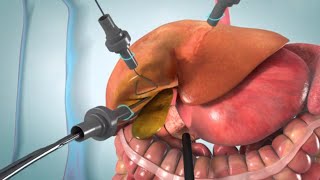 Laparoscopic and open cholecystectomy surgery animation [upl. by Bilski29]