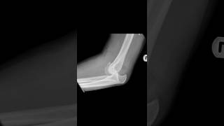 Posterior dislocation of the elbow with associated fracture of the coronoid process xray [upl. by Anyah]