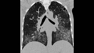 PCP Pneumonia por pneumocystis Jirovecii [upl. by Moretta]