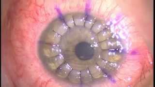 Queratoplastia Penetrante Penetrating Keratoplasty QPPPK  Diamond Shape [upl. by Phelan591]