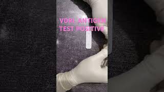 VDRL ANTIGEN TEST POSITIVE medicalcollegestudents youtubeshorts ytshorts lab [upl. by Eytak]