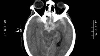 Subarachnoid Hemorrhage CT JETem 2017 [upl. by Farly184]