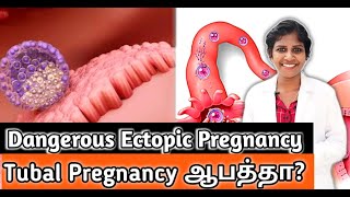 Ectopic Pregnancy ஆபத்துகள்  DrJagadeeswariRajalingam [upl. by Karolyn]