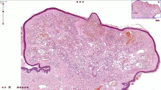 Capillary Hemangioma  Skin Histopathology [upl. by Werra]