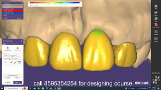 Exocad Video TutorialHow to Design in EXOCAD Anterior Teethin hindi [upl. by Placidia]