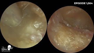 1564  Bilateral Rare Canal Cholesteotoma Patient Waiting 25 Years to be seen by ENT [upl. by Shing743]