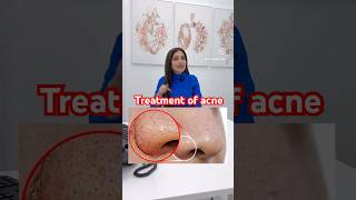 Treatment of acne and white head nose  skincare  skin therapy darkspots ​⁠DrMigraine [upl. by Naie]