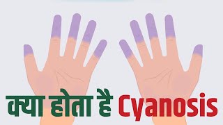 क्या है त्वचा के सायनॉसिस का कारण और इसके लक्षण क्या हैं Cyanosis Common Cause Signs and Symptoms [upl. by Siesser]