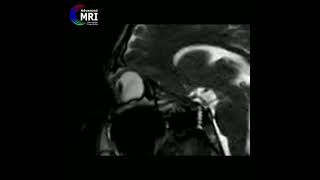 Eye Rubbing on MRI Would you do that again مالش چشم در ام آر آی [upl. by Ardnasal]