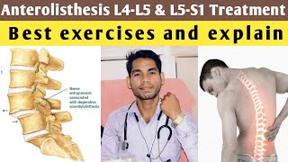 anterolisthesis l5 s1 treatment anterolisthesis grade 1 treatment exercises l4 l5 lumbar spine [upl. by Gilberte58]