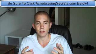 Acne Home Remedies  Get Rid Of Acne Safely From Home [upl. by Ahron]