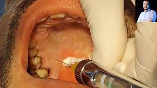 Local Anesthesia Greater Palatine Nerve Block Technique Maxillary anesthesia Techniques dentistry [upl. by Eerac]